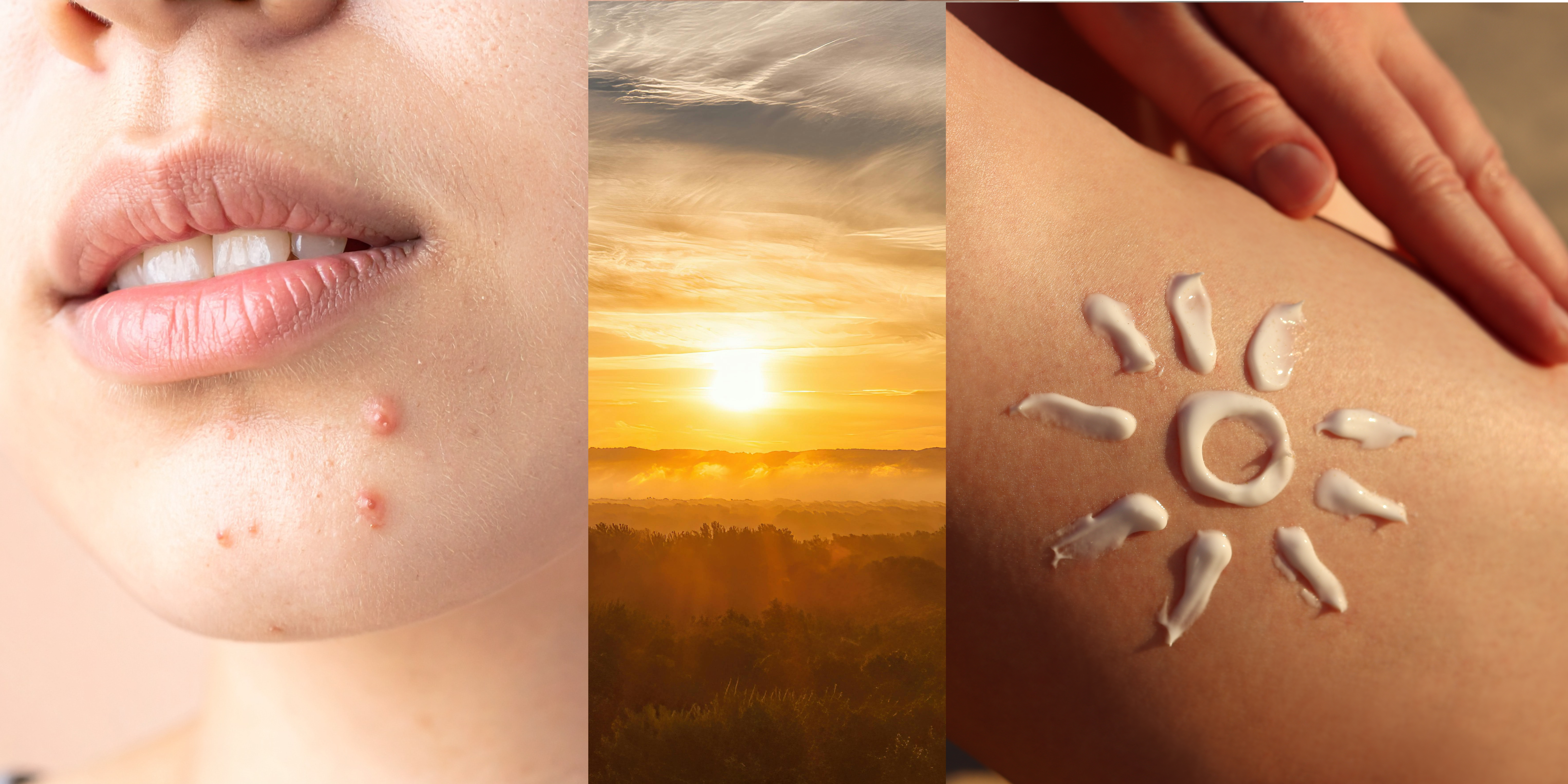 Slunce pleť nelepší, to je mýtus. Opalovací krém patří i na akné, říká dermatoložka MUDr. Kičmerová